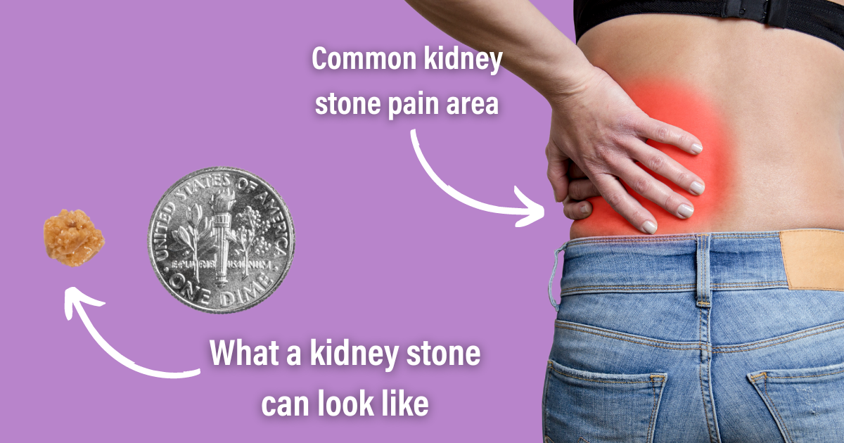 Common Kidney Stone Pain Area